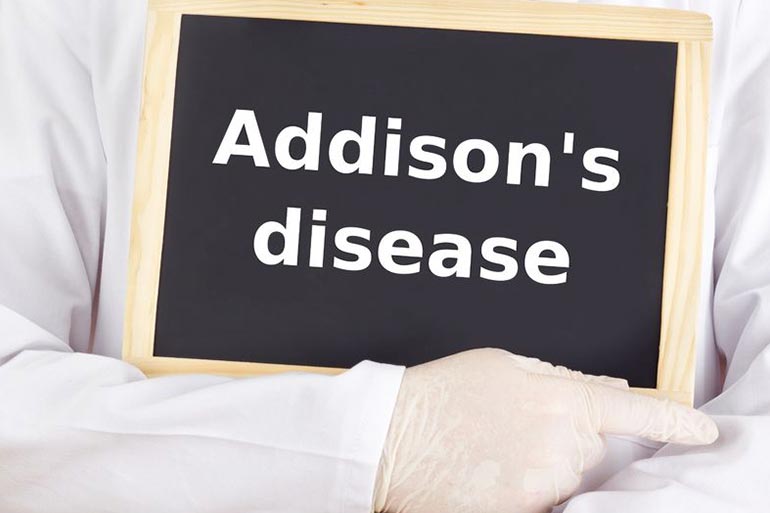Dark spots on the tongue are a major symptom of Addison’s disease
