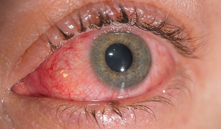 Pink eye is usually mild and heals on its own.