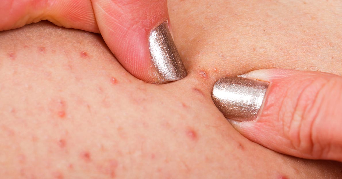 The scientific reason behind why pimple popping videos are so popular