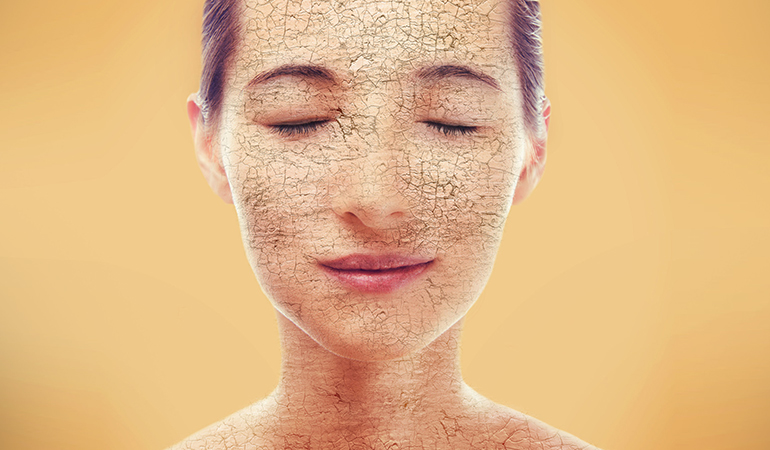 Anti-acne antibiotics can cause dryness and peeling.