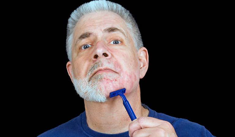 Barber’s itch is characterized by symptoms like pustules and small bumps on bearded areas