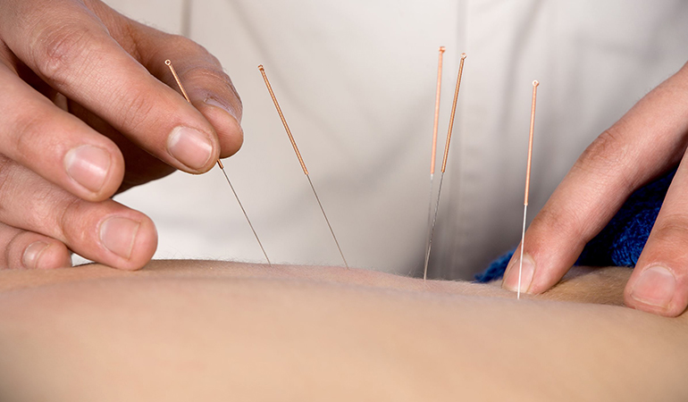 Acupuncture reduces pain, nausea, vomiting, hot flashes, and anxiety