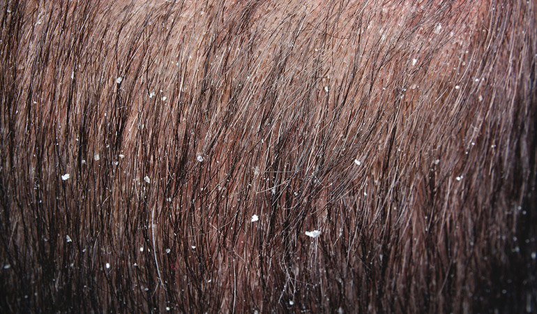 Dryness can make the skin crack and break off to form dandruff