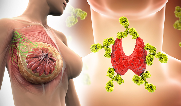 Thyroid pills increase breast cancer risk.