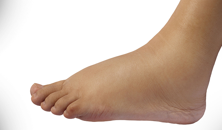 Swollen legs and feet may be a sign of a faulty heart valve that refuses to close properly.