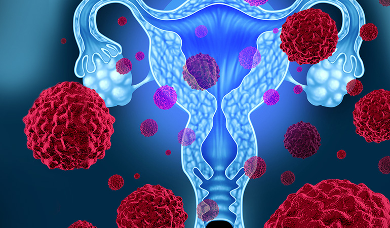 Taking birth control pills, obesity, and taking estrogen after menopause may lead to uterine cancer