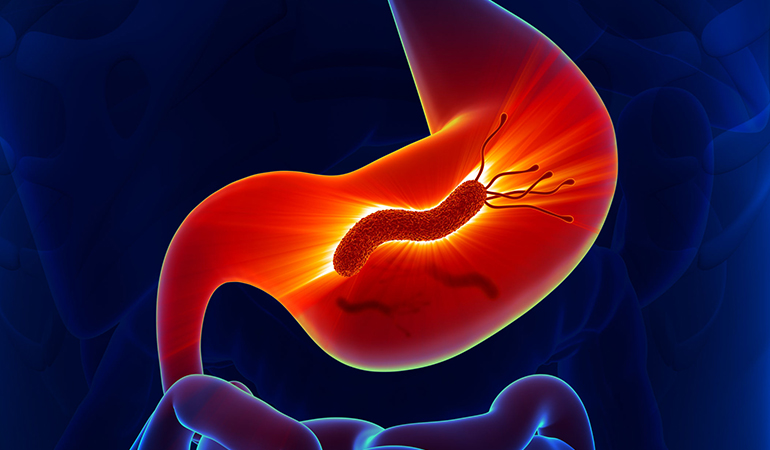 H. pylori infection occurs in more than half of the world's population