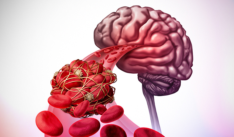 Causes of an aneurysm and stroke