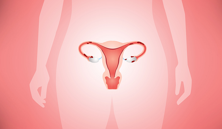 Endometriosis causes abnormal spotting.