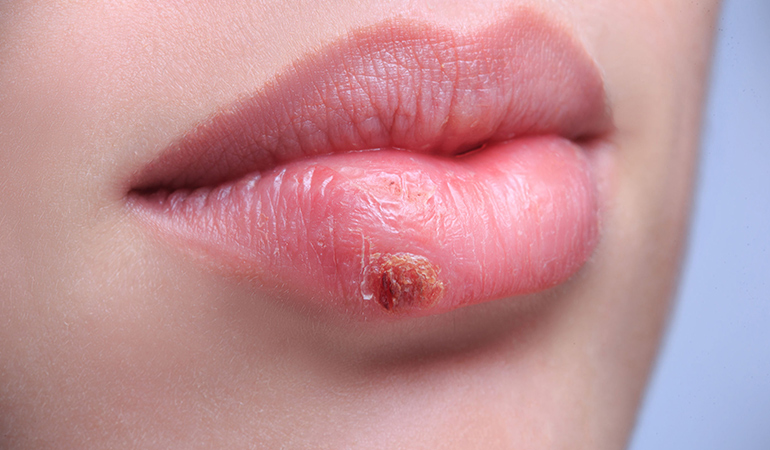 Oral herpes may be accompanied by blisters on the lips, which result in painful sores on rupturing
