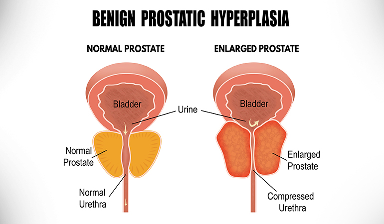 As the prostate grows larger, it can squeeze the urethra, causing painful urinary symptoms.