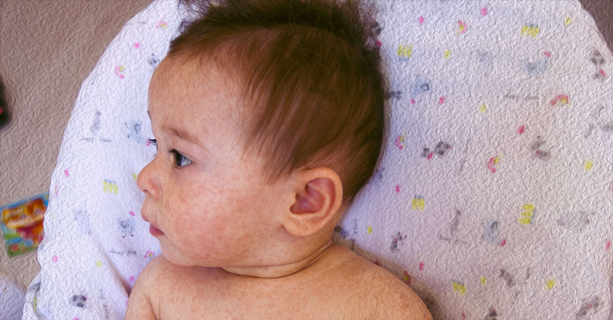 Natural remedies for baby eczema include coconut oil and chamomile oil.